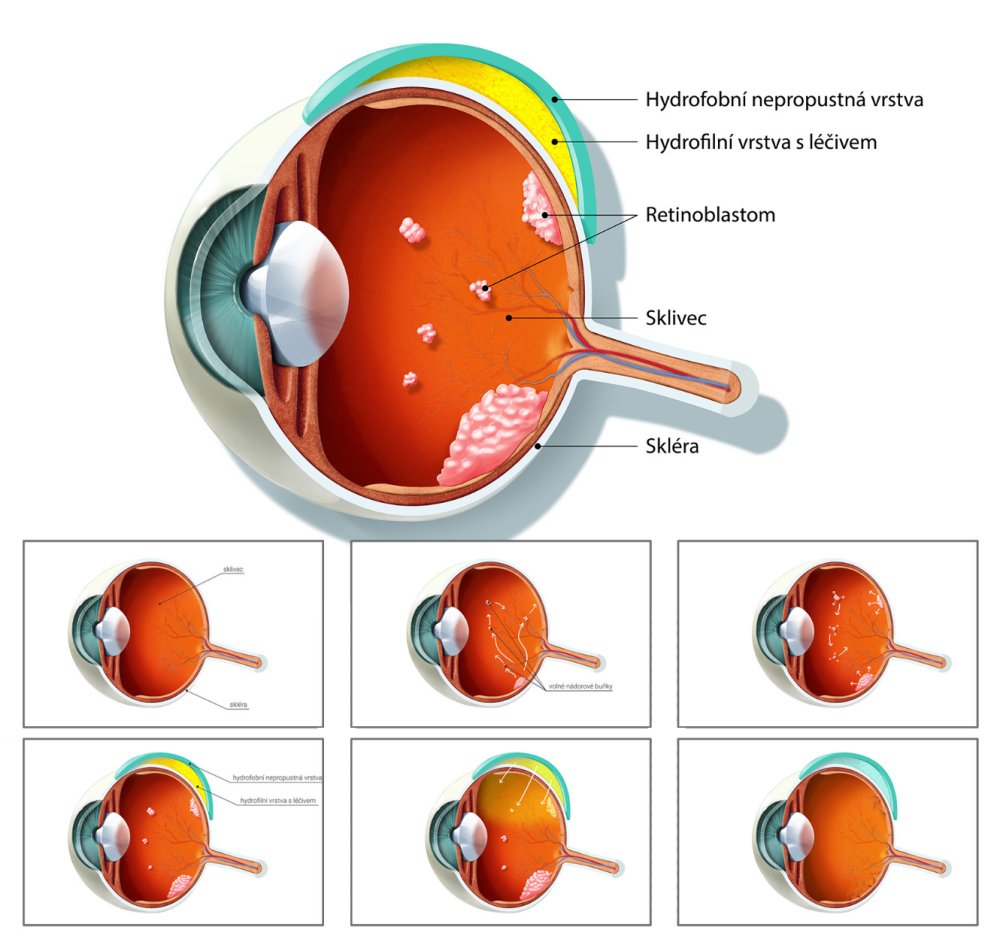 Nová léčba očního nádoru retinoblastomu